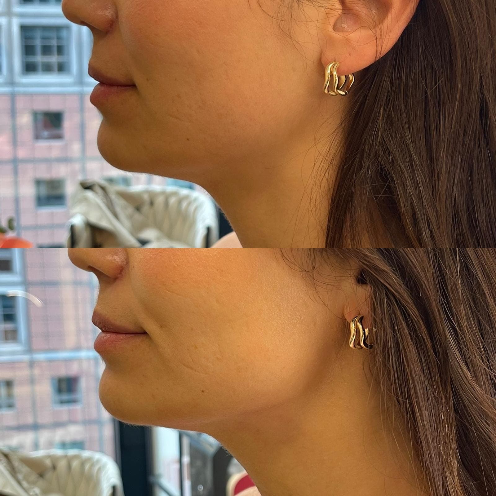 Bodyshaping München – definierte Jawline und Konturen bei Nue Beauty