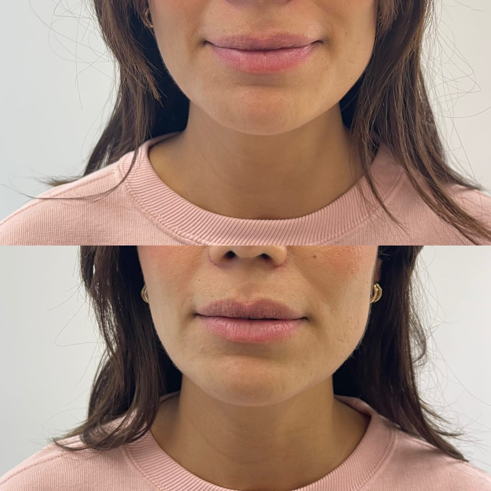 Body Shaper Jawline Vorher Nachher München – Konturierung bei Nue Beauty