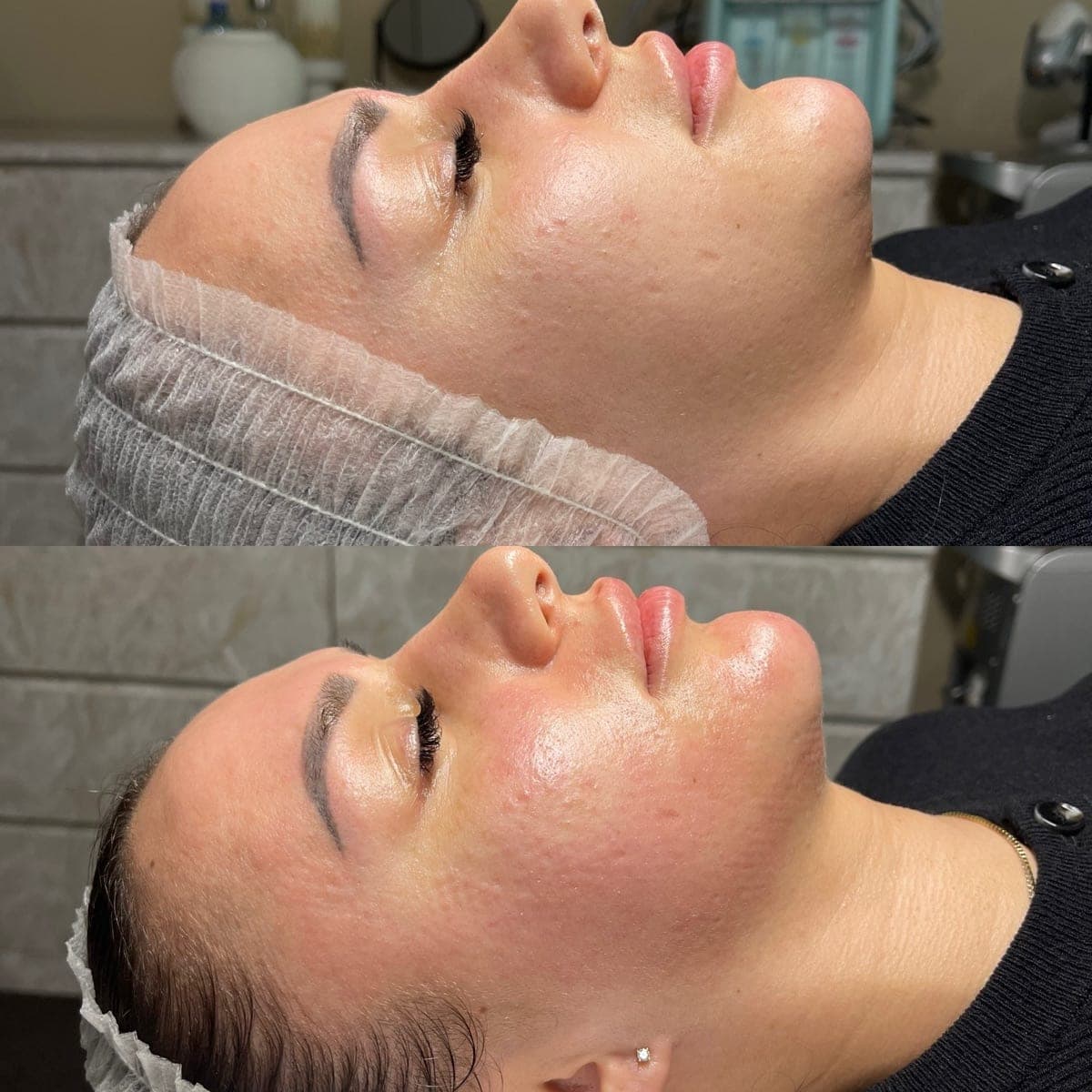 RF Crystal Microneedling — Hautverfeinerung — Vorher/Nachher